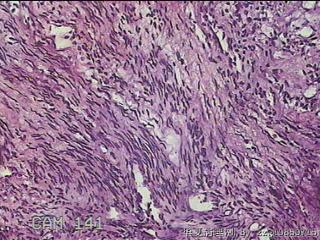 子宫粘膜下肌瘤图31
