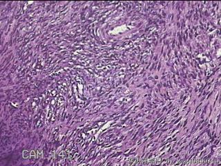 子宫粘膜下肌瘤图28