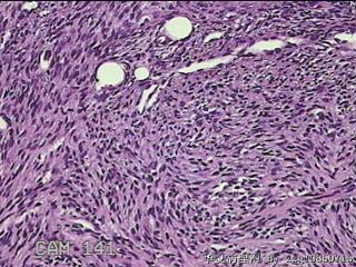 子宫粘膜下肌瘤图23