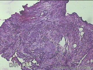 子宫粘膜下肌瘤图11