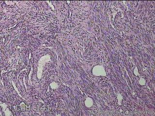 子宫粘膜下肌瘤图13
