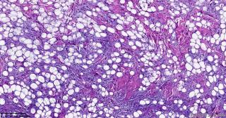 脂肪母细胞瘤？图1
