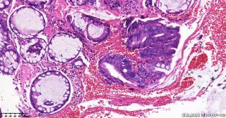 直肠隆起，锯齿状腺瘤伴管状绒毛状腺瘤，有高级别的地方吗？图6
