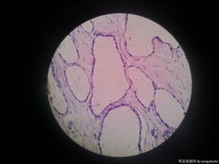 浆液性囊腺癌，包膜大小不等腺体也是癌吗？图1