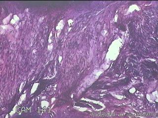 子宫腔粘膜下肌瘤图3