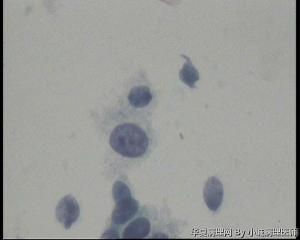 请老师看看48岁TCT，这些裸核细胞怎么报？图5