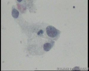 请老师看看48岁TCT，这些裸核细胞怎么报？图13