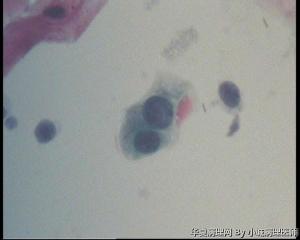 请老师看看48岁TCT，这些裸核细胞怎么报？图8