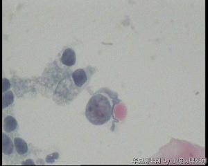请老师看看48岁TCT，这些裸核细胞怎么报？图3