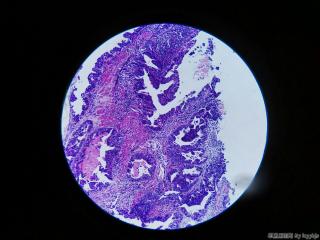 食管活检图9