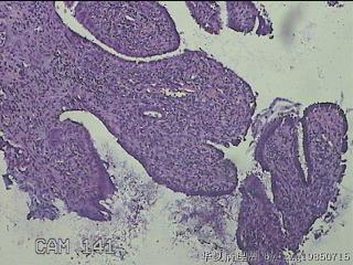 宫颈息肉图6
