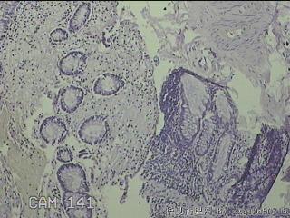 直肠息肉 肛周组织图30