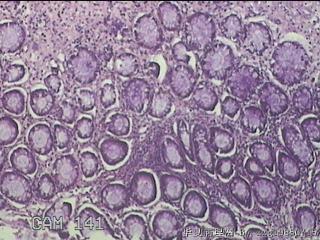 直肠息肉 肛周组织图19
