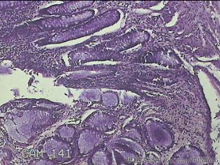 直肠息肉 肛周组织图13