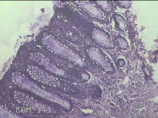 直肠息肉 肛周组织图16