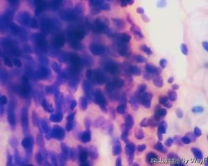 普通宫颈细胞学筛查病例图6