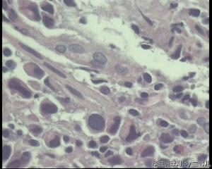 请教老师，贲门活检，能直接报贲门低分化腺癌吗？图5