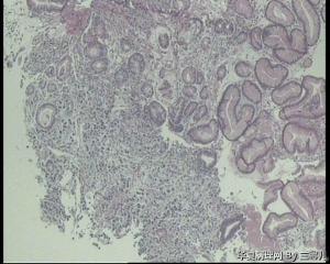 请教老师，贲门活检，能直接报贲门低分化腺癌吗？图14