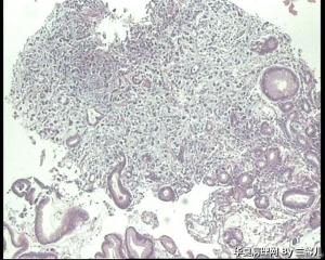 请教老师，贲门活检，能直接报贲门低分化腺癌吗？图7