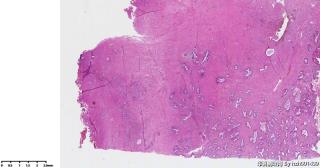 子宫肌瘤行子宫全切标本，请老师们帮看看这些腺体？图2