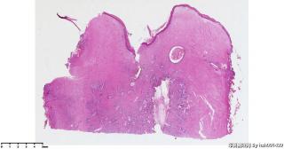 子宫肌瘤行子宫全切标本，请老师们帮看看这些腺体？图1