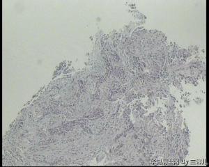 食道活检，低分化鳞癌吗？图11