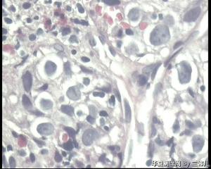 食道活检，低分化鳞癌吗？图4