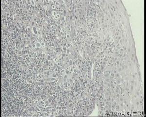 食道活检，低分化鳞癌吗？图2