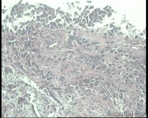 食道活检，低分化鳞癌吗？图10