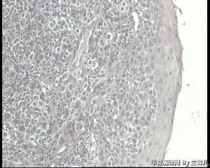 食道活检，低分化鳞癌吗？图6
