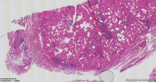 请老师们帮看看这个甲状腺的这些区域？嗜酸细胞腺瘤？图2