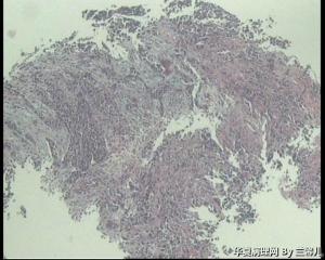 食道活检，低分化鳞癌吗？图7