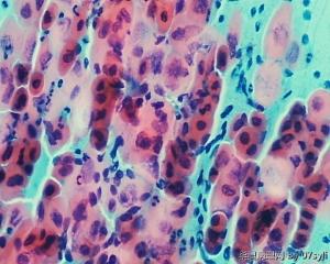宫颈细胞学图6