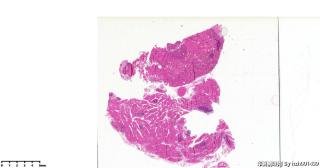 请老师们帮看看这个甲状腺的这些区域？嗜酸细胞腺瘤？图9