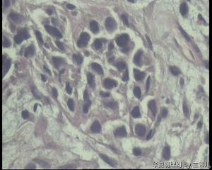 食道活检，低分化鳞癌吗？图13