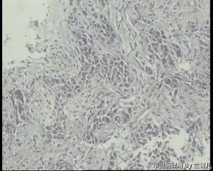 食道活检，低分化鳞癌吗？图12