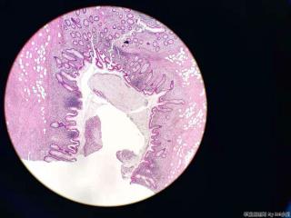 阑尾粘液性囊肿？图4