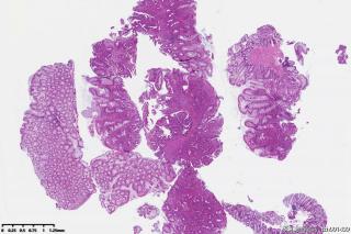 直肠占位，高级别腺上皮瘤变？局灶癌变？图4