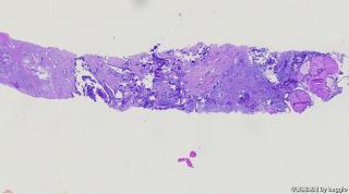 甲状腺穿刺图1