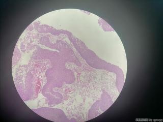 膀胱赘生物图8