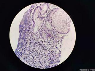 胃体活检，低分化腺癌？图6