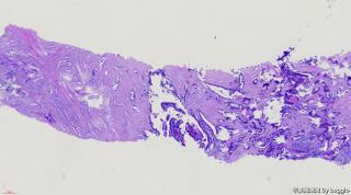 甲状腺穿刺图7