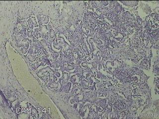 双侧鼻腔新生物图17