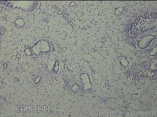 双侧鼻腔新生物图8