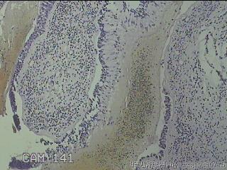 双侧鼻腔新生物图25