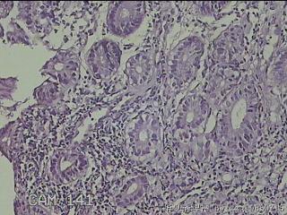 回肠末端粘膜图12