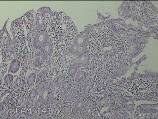 回肠末端粘膜图1