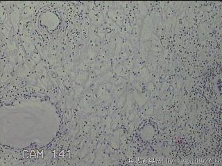 双侧鼻腔新生物图21