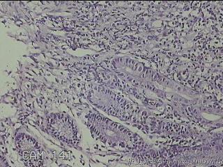 回肠末端粘膜图18