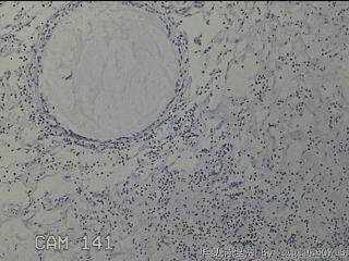 双侧鼻腔新生物图15